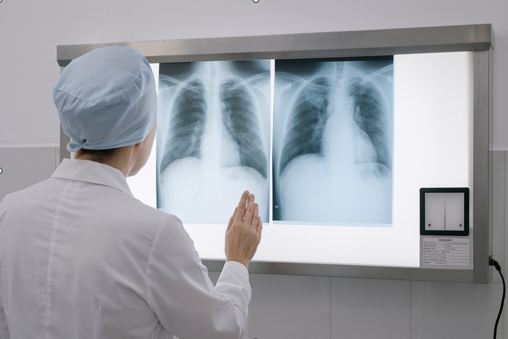 Read more about the article Distributor Alkes Makassar dan Pentingnya X-Ray Film Viewer dalam Penanganan TBC